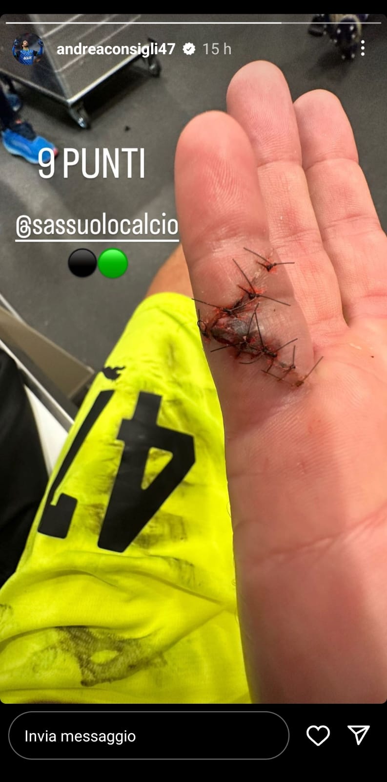 infortunio andrea consigli mano